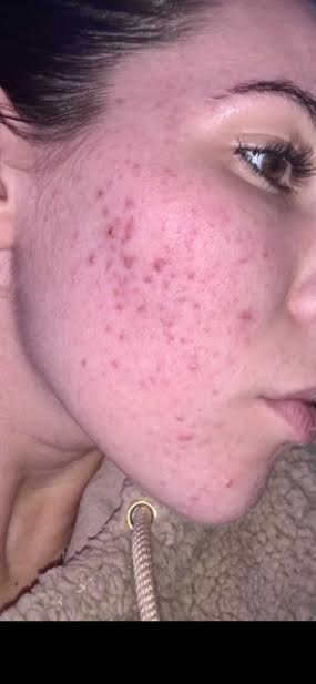 Acne Before
